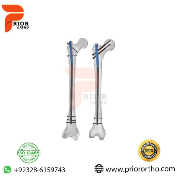 Ulna Nail 2 System
